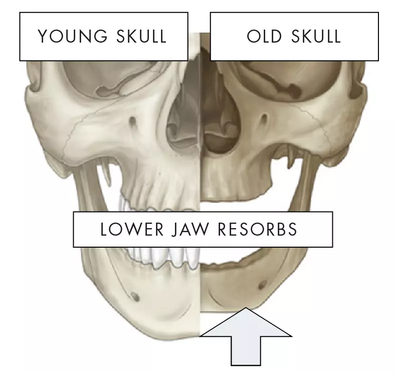 Jaw resobts - double chin liposuction