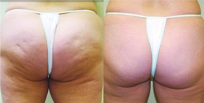 Cellulite behandeln mit Carboxytherapie