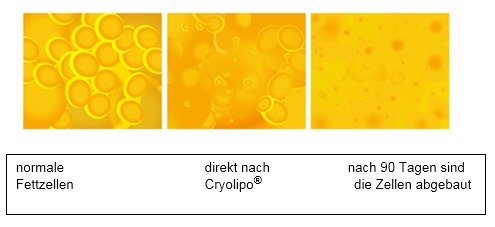 Abbau des Fettgewebes: das abgebaute Fettgewebe bildet sich nicht wieder nach