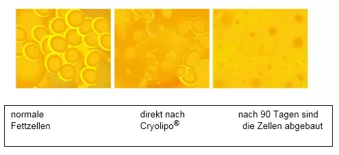 Abbau des Fettgewebes: das abgebaute Fettgewebe bildet sich nicht wieder nach