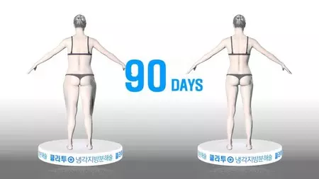 Die Resultate der Kryolipolyse mit CoolSculpting® von der Firma Zeltiq® sind nach etwa 90 Tagen zu sehen