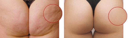 Die Mesotherapie am Po regt die Mikrozirkulation an, so bildet sich Cellulite nachhaltig zurück