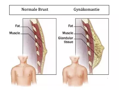 Normale Brust versus Gynäkomastie - vergrösserte Brust beim Mann