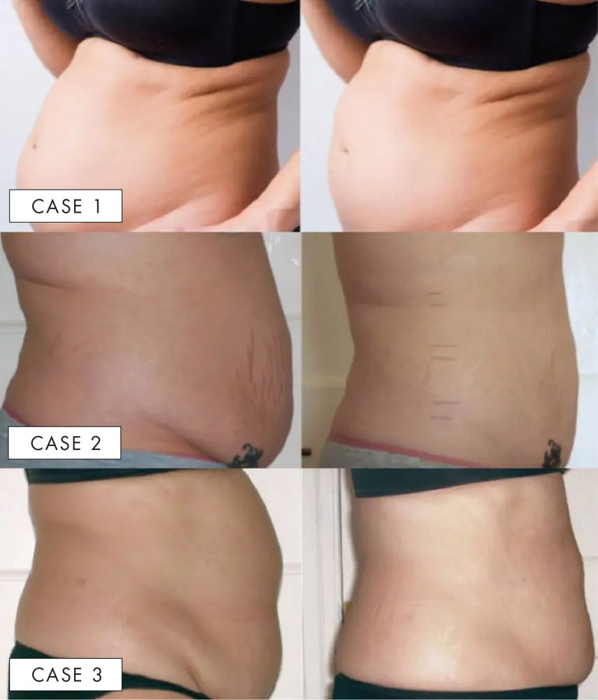 Realistic results of belly liposuction