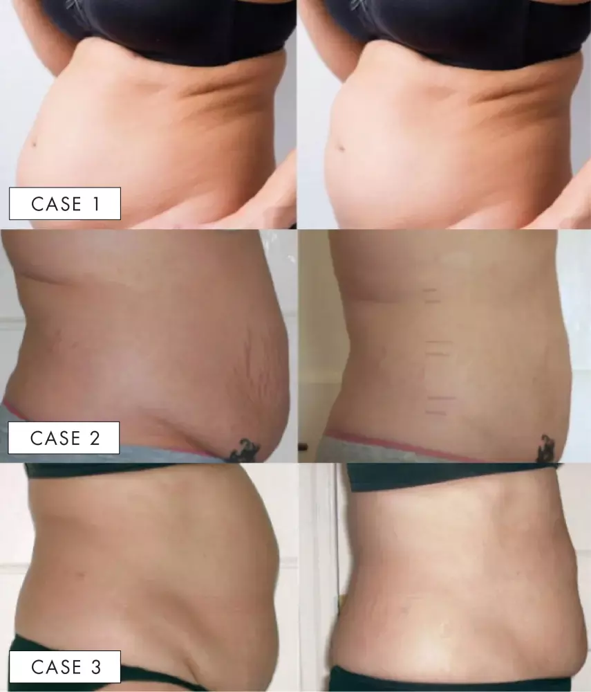 Realistic results of belly liposuction