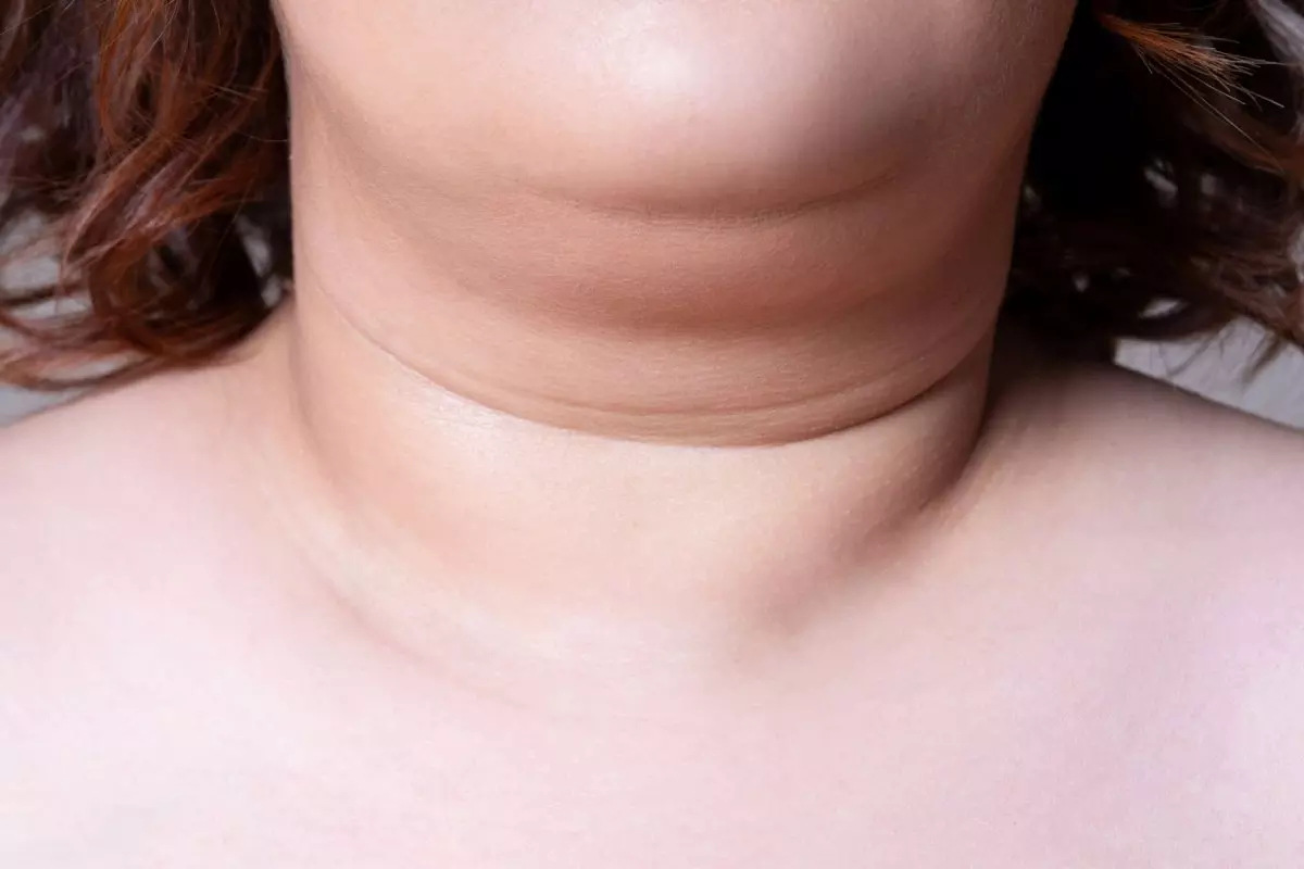 Double chin removal