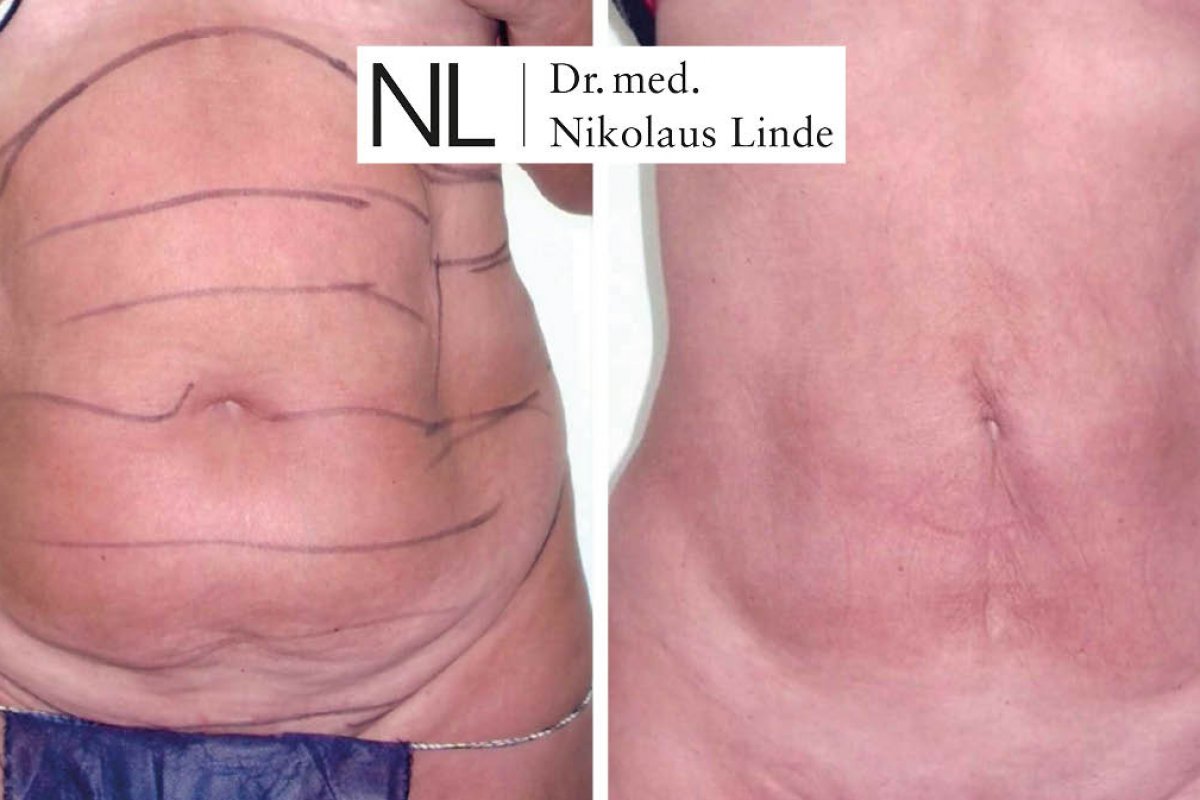 Fettabsaugung Bauch Renuvion