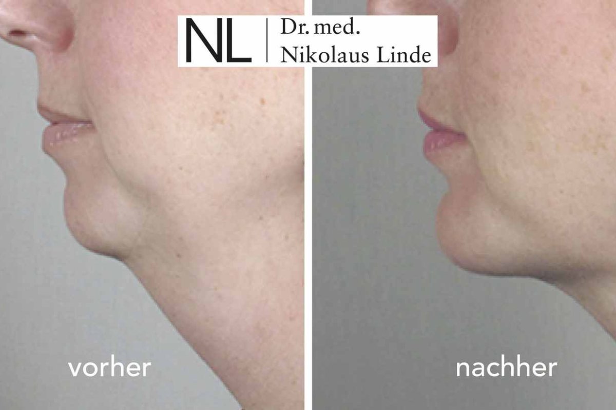 Doppelkinn entfernen