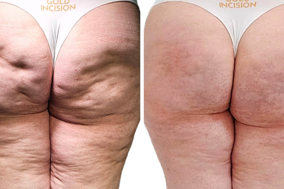Gold Incision